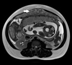 Thumbnail of T2-weighted magnetic resonance imaging sequence of the pregnant woman’s abdomen demonstrating an omental mass of intermediate intensity (white arrow) anterior to the uterus.