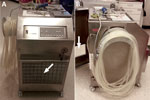 Thumbnail of Custom-made stainless steel housing for heater–cooler units (Sorin/LivaNova 3T, Milan, Italy) used at the University Hospital Zurich, Zurich, Switzerland. A) Front view shows the fine dust filter F7 over the air inlet (arrow). B) Side view shows the half-open back door with the rectangular opening (arrow), through which a duct connects the housing to the operating room ventilation exit. The negative pressure of the operating room ventilation system generates the necessary airflow.