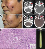 Thumbnail of Mycobacterium gordonae infection in a 60-year-old immunocompetent woman, China. A) Facial lesions before treatment. Ulcers were erythematous and covered with yellow crusts. B) Computed tomography images before treatment show heterogeneous hypersignal in the ethmoid and left maxillary sinus (arrows). C) Facial lesions after treatment. Atrophic scars are seen at sites of previous lesions. D) Computed tomography images after treatment show recovery of the ethmoid sinus and left maxilla