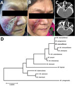Thumbnail of Skin lesions and computer tomography scans of woman with Mycobacterium marseillense skin infection, China, 2018, and genomic analysis of isolate. A, B) Facial skin lesion of woman with M. marseillense infection before and after treatment. Infiltrated erythematous plaque with yellowish scales and crusts (A) resolved to a scar after clearance of infection (B). C) Computed tomography imaging before treatment (top) shows heterogeneous hypersignal in right ethmoid sinus and after treatme