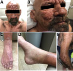 Lepromatous leprosy in a 54-year-old man in central Florida, USA, 2022. A, B) Leonine facies with waxy yellow papules. C) Violaceous nonblanching macules coalescing into patches along dorsum of feet bilaterally. D, E) Erythematous papules coalescing into plaques along extensor aspects of upper and lower extremities bilaterally. Plaques notably demonstrated a moderate degree of dysesthesia.