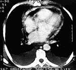 Thumbnail of Q-fever pneumonia.