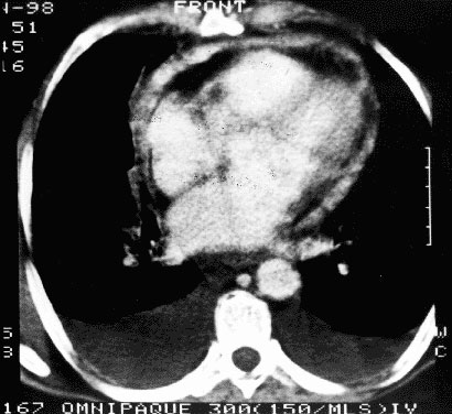 Q-fever pneumonia.