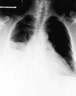 Thumbnail of CT scan of heart, showing thickened pericardium.