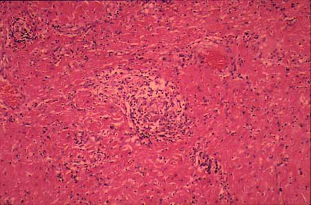 Histologic results of pericardial biopsy, which show granulomatous pericarditis.