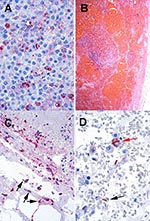 Thumbnail of A. Pleural fluid cell block from a nonfatal case showing abundant Bacillus anthracis granular antigen staining inside mononuclear inflammatory cells. (Immunohistochemical assay with a mouse monoclonal anti-B. anthracis capsule antibody and detection with alkaline phosphatase and naphthol fast red, original magnification 158X). B. Mediastinal lymph node from a fatal case of anthrax showing extensive capsular and sinusoidal hemorrhage. (Hematoxylin and eosin, original magnification 25