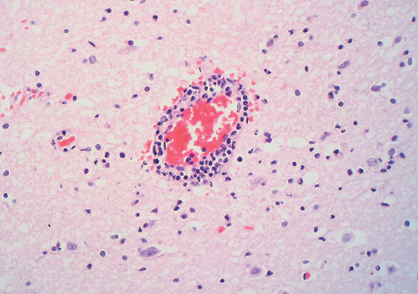 Perivascular cuffing in the brain. (Hematoxylin and eosin stain, original magnification x 200).