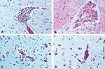 Thumbnail of Representative histopathologic changes of brains of infected equines. A. Cerebrum, horse no. 3 (strain OAX131), showing perivascular cuff of lymphocytes (original magnification x200, hematoxylin and eosin [H&amp;E] stain). B. Cerebrum, horse no. 4 (strain CPA201), showing perivascular cuff of lymphocytes (original magnification x200, H&amp;E stain). C. Cerebral gray matter, horse no. 2 (strain OAX131), showing infiltration of mononuclear cells into brain parenchyma (original magnifi