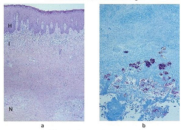 a, Hematoxylin and eosin stain of a lesion specimen showing definitive Buruli ulcer disease in the preulcerative stage (original magnification 50x). Notice the psoriasiform epidermal hyperplasia (H), superficial dermal lichenoid inflammatory infiltrate (I), and necrosis of subcutaneous tissues (N). b, Ziehl-Neelsen stain of the same nodule, showing abundant colonies of acid-fast bacilli in the necrotic subcutaneous tissues (original magnification 100x).