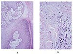 Thumbnail of a, hematoxylin and eosin stain of the pseudoepitheliomatous hyperplasia of the epidermis in a lesion specimen showing definitive Buruli ulcer disease in the ulcerative stage (original magnification 100x). b, hematoxylin and eosin stain of the necrotic collagen (c) accompanied by mild inflammatory infiltrate in the dermis of a definitive Buruli ulcer disease lesion in the ulcerative stage (original magnification 400x). n, neutrophis; m, mononuclear cells.