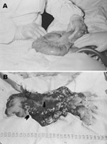 Thumbnail of A. Severe edema of a small bowel loop in intestinal anthrax with a large mesenteric lymph node held between the surgeon’s fingers. B. Same segment of bowel opened after resection. Edema, necrosis, and mucosal hemorrhages exist. A central eschar (arrow) and small surrounding nodules (arrowhead) are reminiscent of the cutaneous lesions of anthrax.