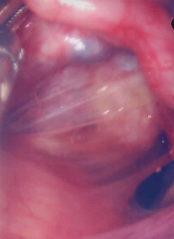 Diffuse coalescences between uterus and fallopian tubes (the ovary is hidden behind the uterus).