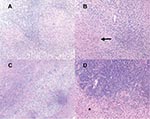 Thumbnail of Hematoxylin and eosin–stained sections from patient 1 (panels A, B) and patient 2 (panels C, D). Note the predominantly lymphohistocytic infiltrate forming large granulomas (A, original magnification 100x); well-formed giant cells (B, arrow, original magnification 200x); lymphohistiocytic infiltrates distorting brain parenchyma and forming vague granulomas (C, original magnification 40x); and the dense astrogliosis at the interface between granulomatous inflammation and surrounding