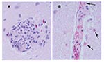 Thumbnail of Perivascular changes observed within the brain of alligators infected with West Nile virus (400x). A. Perivascular infiltrates were composed of primarily lymphocytes, plasma cells, and macrophages in the hatchling alligator. B. Perivascular infiltrates were composed of primarily heterophils (arrows) in juvenile alligators.