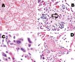 Thumbnail of Pathologic findings of lung tissue sections. A: Pulmonary congestion and edema (H&amp;E stain, original magnification x100). B: A mild degree of interstitial lymphocytic infiltration. Intra-alveolar organizing exudative lesion was occasionally found. Detached atypical pneumocytes indicated by arrow (H&amp;E stain, original magnification x200). C: Atypical multinucleated pneumocytes were occasionally identified. Definite viral inclusion was not apparent (H&amp;E stain, original magni