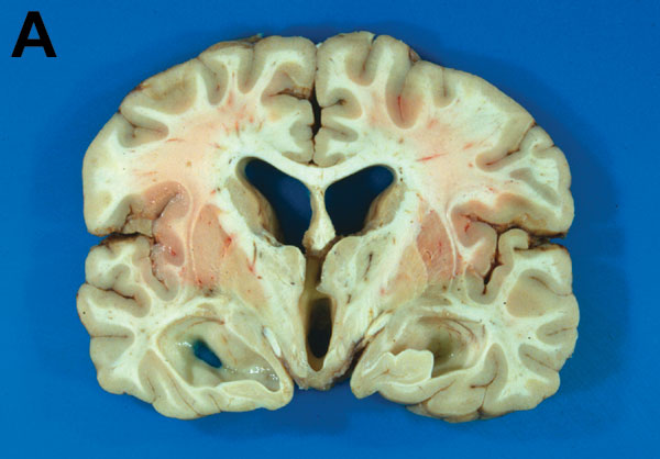 A) Coronal section of brain showing dilation of ventricles, flattening of the cerebral gyri, and uncal herniation. B) Intact cysticercus occupying the 4th ventricle