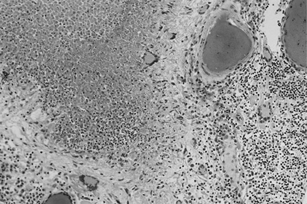 Meningeal infiltrate with caseation necrosis surrounded by giant cells. A nearby vessel is surrounded by a mononuclear cell infiltrate (occipital lobe, x250, stained with hematoxylin and eosin–Luxol-fast blue).