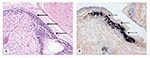 Thumbnail of Histologic section through the anterior gastric chamber of a moribund juvenile Litopenaeus vannamei that was injected with an inoculum prepared with tissue cell culture media from BGMK cells exposed to Taura syndrome virus (TSV) (day 7 postexposure). A) The arrows point to a portion of cuticular epithelium displaying diagnostic acute-phase TSV lesions (hematoxylin/eosin-phloxin stain; 50x). B) The dashed arrows point to a portion of the stomach epithelium from the same shrimp, where