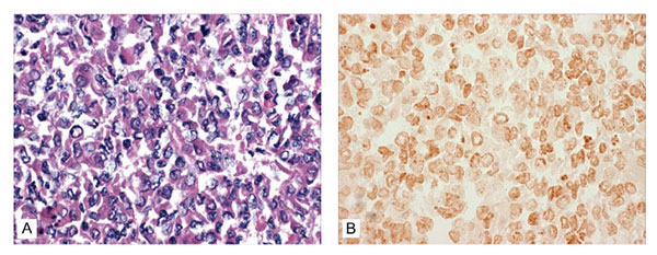 Absence of reaction by in situ hybridization (ISH) to the digoxigenin (DIG)-labeled Taura syndrome virus (TSV) probes within the BGMK cells harvested at day 7 postinjection with TSV. A) No cytopathic effect suggestive of TSV infection was evident by conventional hematoxylin/eosin-phloxin (H&amp;E) histology (H&amp;E stain; 100x). B) Consecutive histologic section to that shown in 4A, but subjected to ISH with DIG-labeled TSV probes specific for TSV. No reaction to TSV is apparent in the challeng