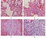 Thumbnail of Pathologic findings from a patient (number 6) with confirmed influenza A (H5N1) infection. All slides are stained with hematoxylin and eosin, shown at 40x objective. Panel A shows hyaline membrane formation lining the alveolar spaces of the lung and vascular congestion with a few infiltrating lymphocytes in the interstitial areas. Reactive fibroblasts are also present. Panel B is an area of lung with proliferating reactive fibroblasts within the interstitial areas. Few lymphocytes a