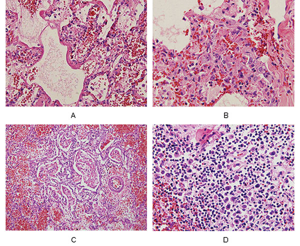 Pathologic findings from a patient (number 6) with confirmed influenza A (H5N1) infection. All slides are stained with hematoxylin and eosin, shown at 40x objective. Panel A shows hyaline membrane formation lining the alveolar spaces of the lung and vascular congestion with a few infiltrating lymphocytes in the interstitial areas. Reactive fibroblasts are also present. Panel B is an area of lung with proliferating reactive fibroblasts within the interstitial areas. Few lymphocytes are seen, and