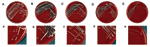 Thumbnail of Sheep blood agar plates (A–E) and magnified sectors (a–e) after overnight incubation at 37°C showing different morphotypes of clonal isolates of the Staphylococcus lugdunensis strain recovered from blood cultures and the infected pocket of a patient with pacemaker infection. Plates A–D/a–d show S. lugdunensis colonies exhibiting the normal phenotype characterized by colonies of different diameter, ranging from 0.8 to 2.5 mm with creamy (A/a) or yellow (B–D/b–d) pigmentation and mode