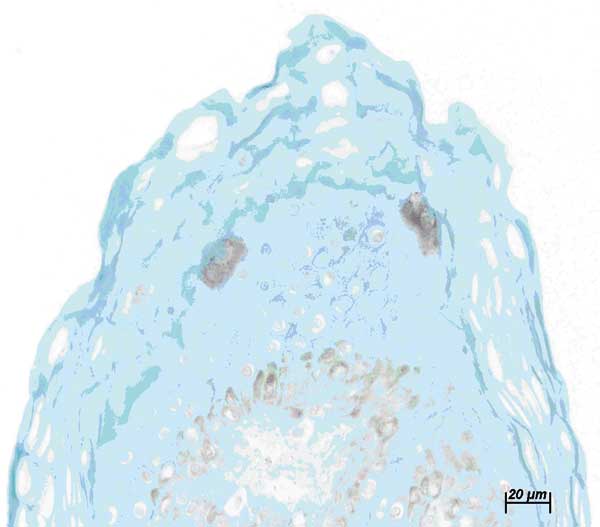 Immunohistochemical stain of neck biopsy specimen. Note positive cells with small intracytoplasmic granules at the border of stratum granulosum and stratum corneum of the epidermis. Bar = 20 μm.