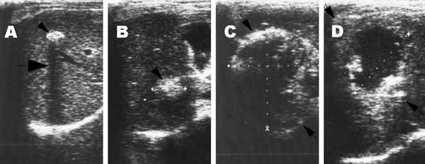 Lesions of alveolar echinococcosis (AE) by abdominal ultrasound examination. A) Calcified lesion: hyperechoic structure with a typical posterior shadow. B) Nodular hyperechoic lesion. C) Typical AE lesion: nonhomogeneous hyperechoic partially calcified area, without central necrosis. D) Typical AE lesion with central necrosis.