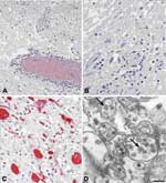 Thumbnail of Histopathologic features of West Nile virus (WNV) in human tissues. Panels A and B show inflammation, microglial nodules, and variable necrosis that occur during WNV encephalitis; panel C shows WNV antigen (red) in neurons and neuronal processes using an immunohistochemical stain; panel D is an electron micrograph of WNV in the endoplasmic reticulum of a nerve cell (arrow). Bar = 100 nm.