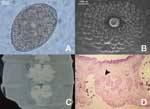 Thumbnail of A) Diphyllobothrium latum egg. Note opercular constriction. B) Genital papillae of mature proglottids as seen under scanning electron microscope. C) Uterine loops of gravid proglottids in fresh preparation. D) Sagittal section of the genital pore region stained with hematoxylin-eosin. Note seminal vesicle (arrowhead) situated dorsocaudal to the cirrus sac (magnification 100×).