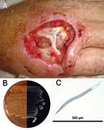 Thumbnail of A) Hand of the patient infected with Photorhabdus asymbiotica after debridement. B) Composite photograph of a culture of P. asymbiotica taken in visible light and in darkness to demonstrate bioluminescence (Luria-Bertani medium). C) Soil nematode from which P. asymbiotica was isolated.