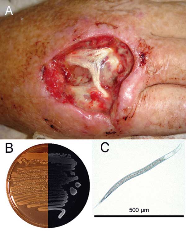 A) Hand of the patient infected with Photorhabdus asymbiotica after debridement. B) Composite photograph of a culture of P. asymbiotica taken in visible light and in darkness to demonstrate bioluminescence (Luria-Bertani medium). C) Soil nematode from which P. asymbiotica was isolated.