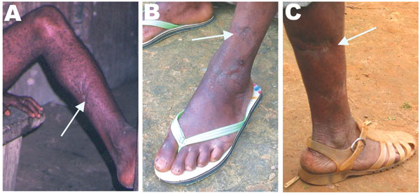 Wounds resulting from bites or scratches from a nonhuman primate. A) Participant no. 801001. B) Participant no. AG16. C) Participant no. 210301.