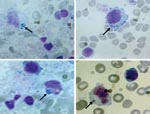 Thumbnail of Peripheral blood smears (buffy-coat preparation) showing variable-sized basophilic inclusions (arrows) in mononuclear cells from a 9-year-old boy with human monocytic ehrlichiosis, Carabobo, Venezuela. Dip Quick (Jorgensen Laboratories, Inc., Loveland, CO, USA) staining; magnification ×1,000.