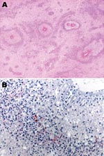 Thumbnail of A) Subcortical cerebral white matter with numerous perivascular foci of demyelination and necrosis (hematoxylin and eosin stain, original magnification ×40). B) Immunohistochemical evidence of Mycoplasma pneumoniae antigen inside macrophages present in the perivascular inflammatory infiltrate (immunohistochemical assay performed by using the monoclonal anti–M. pneumoniae antibody and naphthol fast red as counterstain, original magnification ×100).