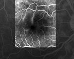 Thumbnail of Fluorescein angiograph of the right eye of the patient showing retinal occlusive vasculitis with arteriolar leakage at late phase.