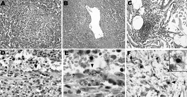 Histopathologic and immunohistochemical labelings of spleen and skin tissue samples. Tissue samples were fixed in 10% formalin, paraffin-embedded, and examined after hematoxylin-eosin staining, Gimenez staining, or immunostaining with the R47 anti-Rickettsia conorii polyclonal rabbit antibody. The spleen red pulp indicated congestion and ill-defined nodules varying in size and comprising macrophages, polymorphonuclear neutrophils, and necrotic cells (A, magnification ×100). A diffuse macrophage