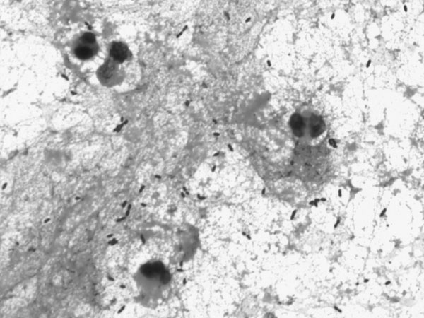 Gram-positive cocci, mostly in pairs, in cerebrospinal fluid from a 68-year-old man with Streptococcus suis meningitis. Magnification ×1,000.