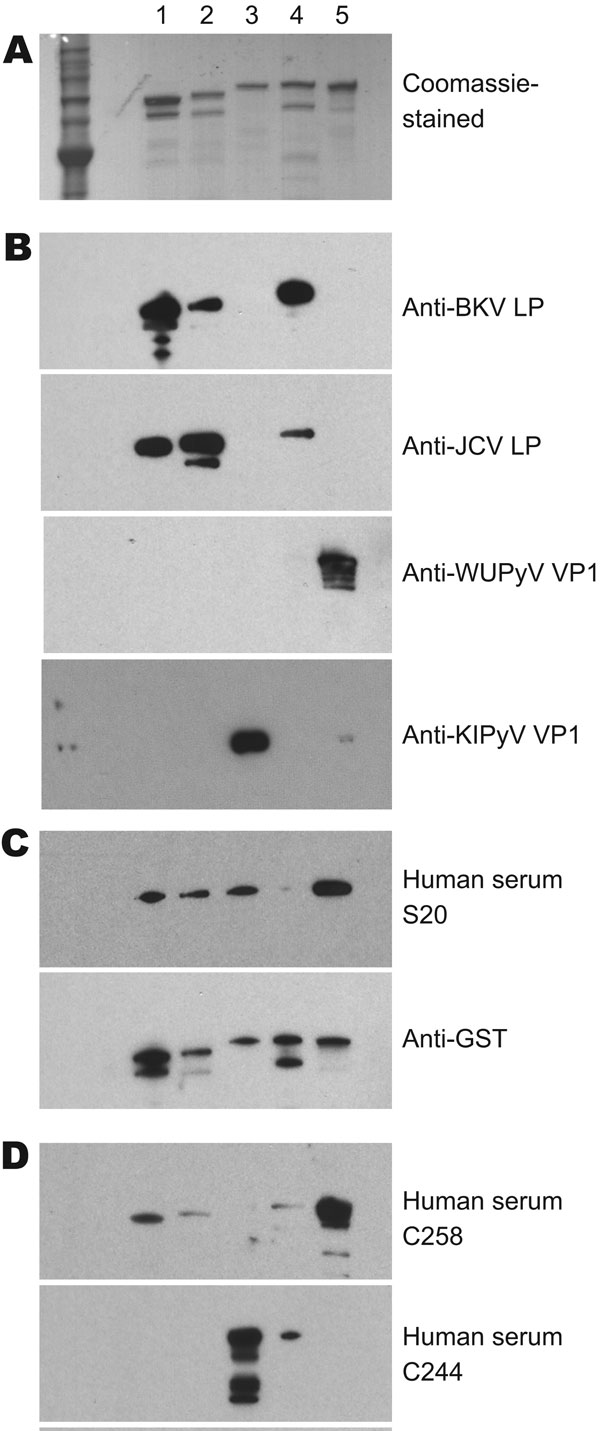 Results of patient serum sample Western blotting for polyomaviruses. A) Coomassie blue–stained image showing 5 types of purified glutathione S-transferase (GST)–tagged viral protein 1 (VP1) in a sodium dodecyl sulfate–polyacrylamide gel. Lane 1, GST-BKV VP1; lane 2, GST-JCV VP1; lane 3, GST–KI polyomavirus (KIPyV) VP1; lane 4, GST-SV40 VP1; lane 5, GST–WU polyomavirus (WUPyV) VP1. B) Western blot results using control rabbit antiserum against BK virus-like particles (BKVLP), JC virus-like particles (JCVLP), WUPyV VP1, or KIPyV VP1 as primary antibody. C) Western blot results for serum that was positive (S20) for WU polyomavirus and KI polyomavirus by ELISA. Antibody against GST was used as a loading control. D) Western blot result for serum that was ELISA positive for WU (C258) and KI (C244).