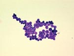 Thumbnail of Gram-positive spherical unicellular organisms in a blood culture from a 79-year-old man with chronic lymphocytic leukemia. Magnification ×1,000.