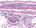 Thumbnail of Proventriculus wall from conure PG8 showing characteristic lymphoplasmacytic infiltration of the subserosal enteric ganglia as well as infiltration of submucosa. This bird had been inoculated 55 days earlier with avian bornavirus, genotype 4. Original magnification ×325.