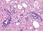 Thumbnail of Lymphoplasmacytic encephalitis with multifocal perivascular cuffing in the cerebrum of conure PG8 inoculated 55 days earlier with avian bornavirus genotype 4. Original magnification ×725.