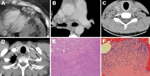 Thumbnail of Radiologic and histologic findings for patients with Granulibacter bethesdensis infections. A) Contrast-enhanced computed tomography (CT) image for patient 2, showing enlarged epigastric nodes (arrow) in the abdomen. B) Contrast-enhanced CT image for patient 3, showing lymphadenopathy (arrow). The heterogeneity of the lymph node suggests necrosis. C) Noncontrast CT image of the spine for patient 4, showing enlarged cervical lymph nodes (arrow). D) Contrast-enhanced CT image for pati