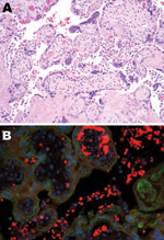 Thumbnail of Tissue sample from 30-year-old primigravida patient exposed to seasonal influenza (H1N1). A) Intervillous (maternal) spaces with clusters/sheets of histiocytes (chronic intervillositis) and fibrotic fetal chorionic villi with Hofbauer cells–histiocytic inflammation (hematoxylin and eosin stain, original magnification ×200). B) Dual-stained immunofluorescent assay showing antibodies to influenza A virus (H1N1) (tetramethylrhodamine isothiocyanate, red) and cytokeratin (fluorescein is