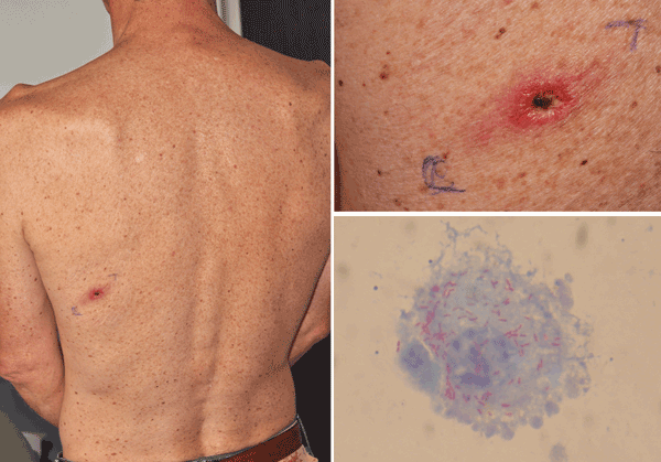 Thumbnail of A) Eschar on the scapular area of a patient infected with Rickettsia sibirica mongolitimonae. B) Close-up view of eschar. C) R. sibirica mongolitimonae growing in L929 cells, stained in red by Gimenez staining.