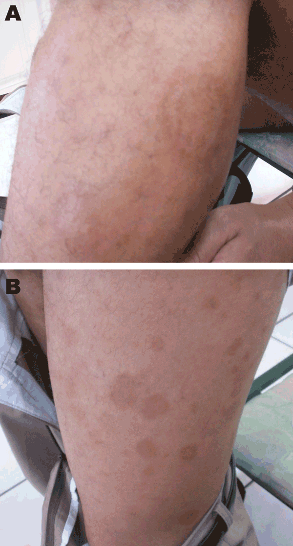 Erythema migrans–like rash on the left leg of a 28-year-old patient. A) Characteristic rash of erythema migrans (annular macular lesion that is erythematous with central clearing). B) Spread of the lesions to the rest of the leg.