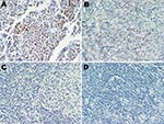 Thumbnail of Merkel cell polyomavirus (MCPyV) large T-antigen (T-ag) expression in human tissues. A) Merkel cell carcinoma stained with CM2B4 antibody as a positive control; MCPyV T-ag was detected. B) Expression of MCPyV T-ag in small lymphocytes in an MCPyV DNA–positive angioimmunoblastic T-cell lymphoma, stained with CM2B4. C) MCPyV DNA–positive reactive lymphoid hyperplasia sample reacted with CM2B4; no T-ag was detected. D) MCPyV DNA-negative chronic lymphocytic leukemia/small lymphocytic l