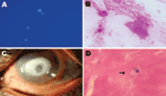 Thumbnail of A) Spherical cysts of Dictyostelium spp. in potassium hydroxide (calcoflour white stain; original magnification ×40) preparation. B) Spherical double wall cysts of Dictyostelium spp. (Gram stain; original magnification ×100). C) Cornea of the patient’s left eye, showing a ring-shaped central infiltrate and central thinning. D) Corneal button showing Dictyostelium spp. cysts (arrow; hematoxylin and eosin stain; original magnification ×100).