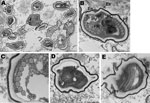 Thumbnail of Spores of Tubulinosema sp. from a 67-year-old woman with Tubulinosema sp. infection, 2009. A) Electron micrograph of numerous spores in various stages in muscle tissue. Scale bar = 2 μm. B) An immature spore showing an electron-dense exospore (Ex) and a thick electron-lucent endospore (En), which together compose the spore wall. Diplokaryon (DK), posterior vacuole (PV), ribosomes in crystalline clusters as polyribosomes (PR) along with the polaroplast and polar filaments (PF) consti