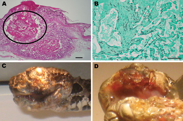 Chrysosporium sp. fungal infection in eastern massasagauga rattlesnake (Sistrurus catenatus catenatus). A) Facial dermatitis and cellulitis caused by Chrysosporium sp. infection in rattlesnake from Carlyle, Illinois, USA; B) close-up showing maxillary fang destruction. C) Maxillary dermal and subcutaneous fungal granuloma (circled area). Hematoxylin and eosin stain, original magnification ×2, scale bar = 500 μm. D) Granuloma center with large numbers of fungal hyphae. Grocott methenamine silver 